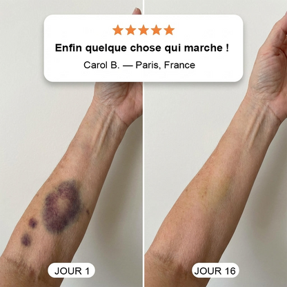 💥 Plus de 100 000 unités vendues 💕 PURELORA® – Crème réparatrice pour les ecchymoses et fortifiante pour la peau